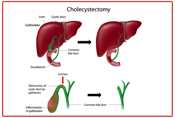 Stomach Cancer Treatment in Delhi NCR – Early Signs, Diagnosis, and Advanced Surgery